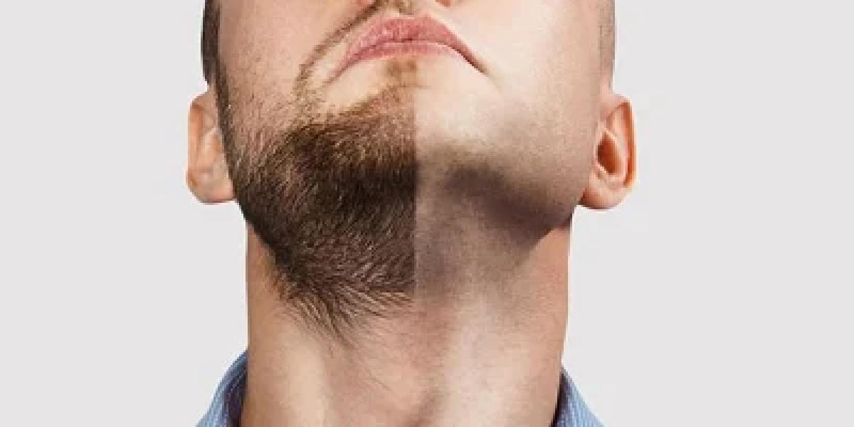 Achieve-a-fuller-beard-with-hair-transplant-technology