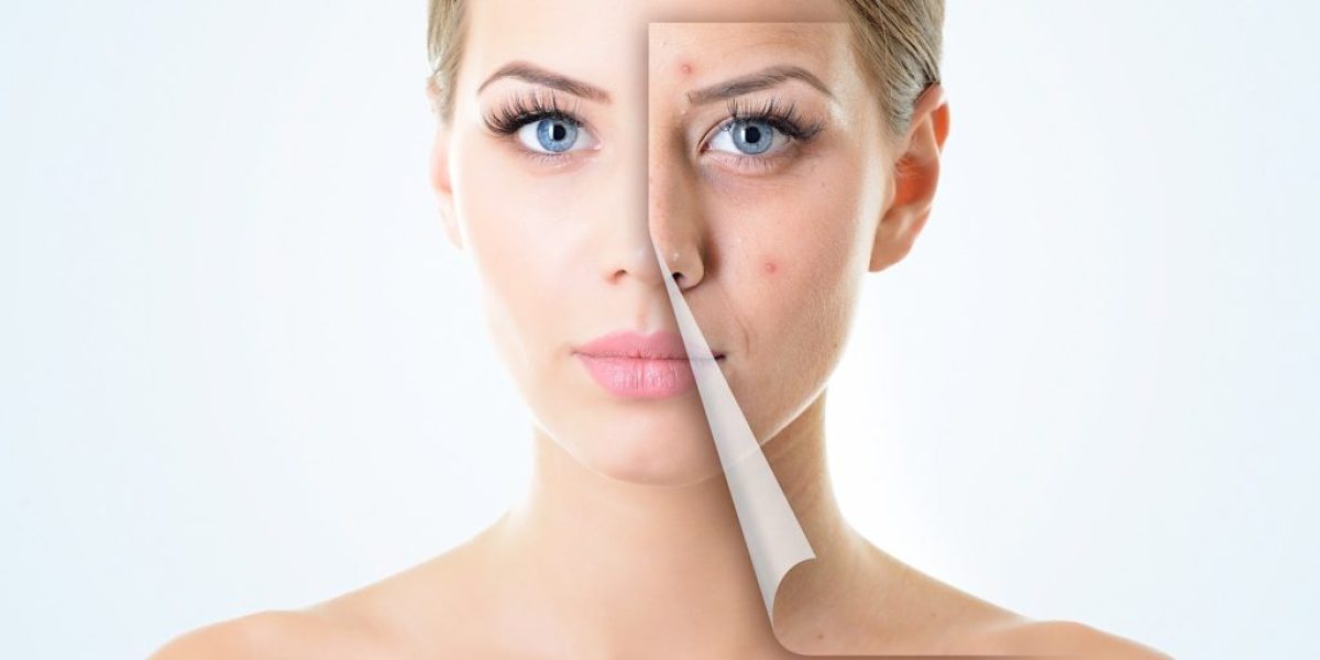 Acne-Scar-Treatment-for-Oily-and-Acne-Prone-Skin