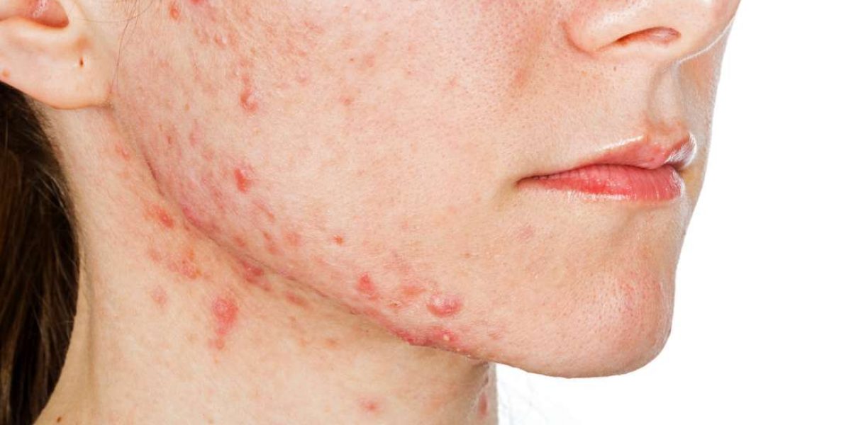 Acne-Scars-Treatment-in-Dubai