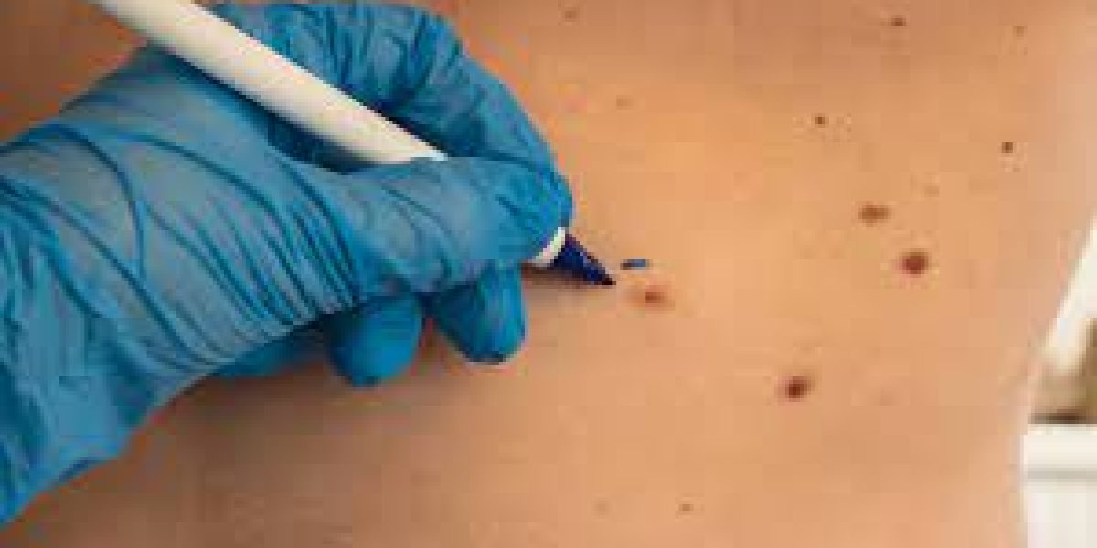 Birthmark-removal-treatments-restore-clearer-even-toned-skin
