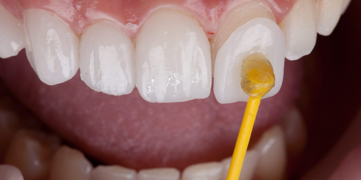 Can-You-Afford-the-Cost-of-Dental-Veneers-Find-Out-Here