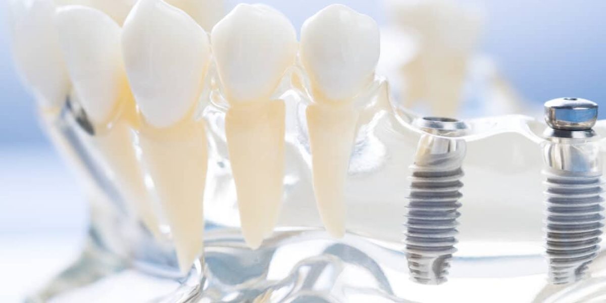 Common-Mistakes-to-Avoid-With-Dental-Implants