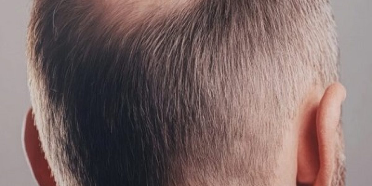 Crown-Hair-Transplant-in-Islamabad
