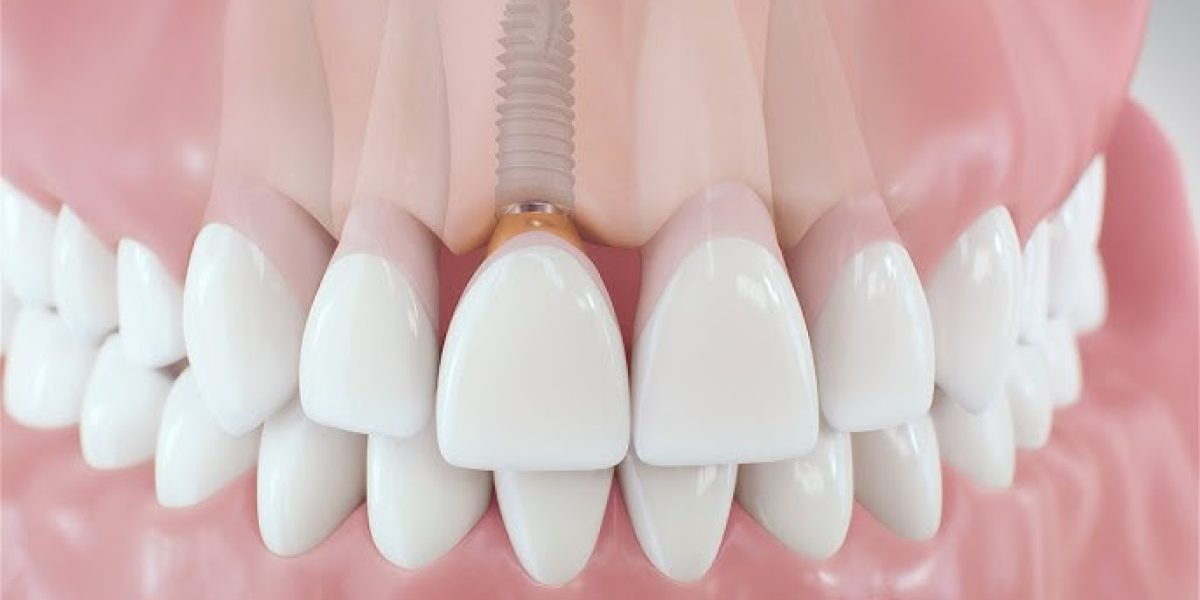 Dental-Implants-Say-Goodbye-to-Dentures
