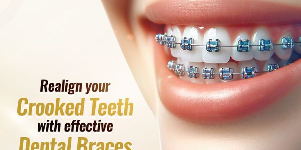 Dental-braces-in-islamabad