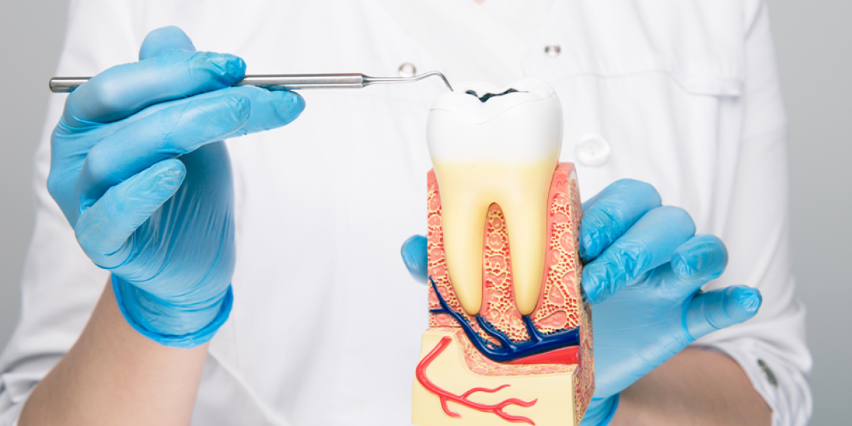 Does-a-Root-Canal-Hurt-The-Truth-About-Pain-and-Discomfort