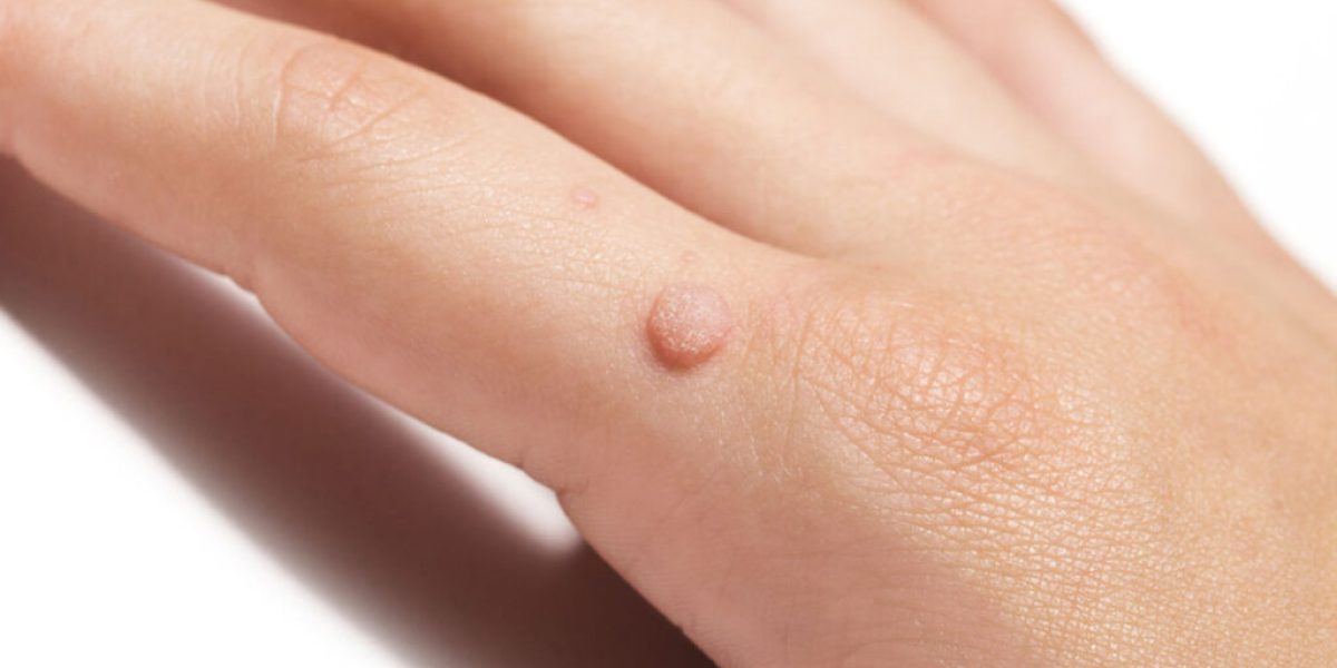 Easy-Steps-to-Help-Remove-Warts-with-Salicylic-Acid