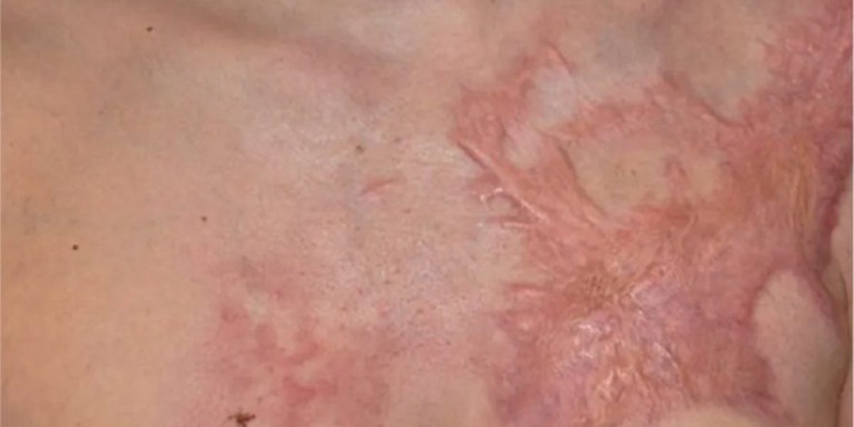 Full-guide-to-reconstructive-burn-surgery