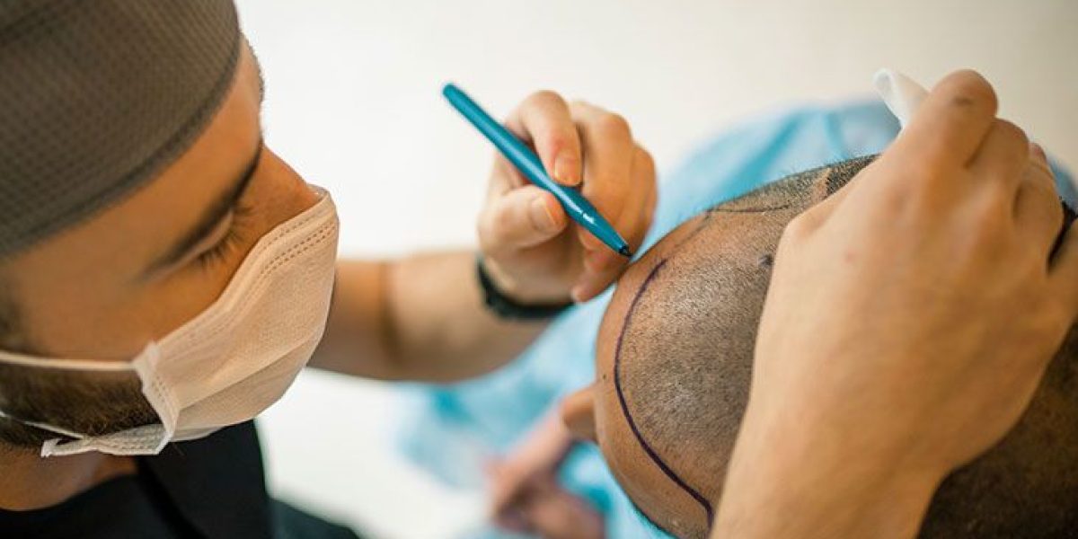 Hair-transplant-restores-thinning-hair-with-natural-results