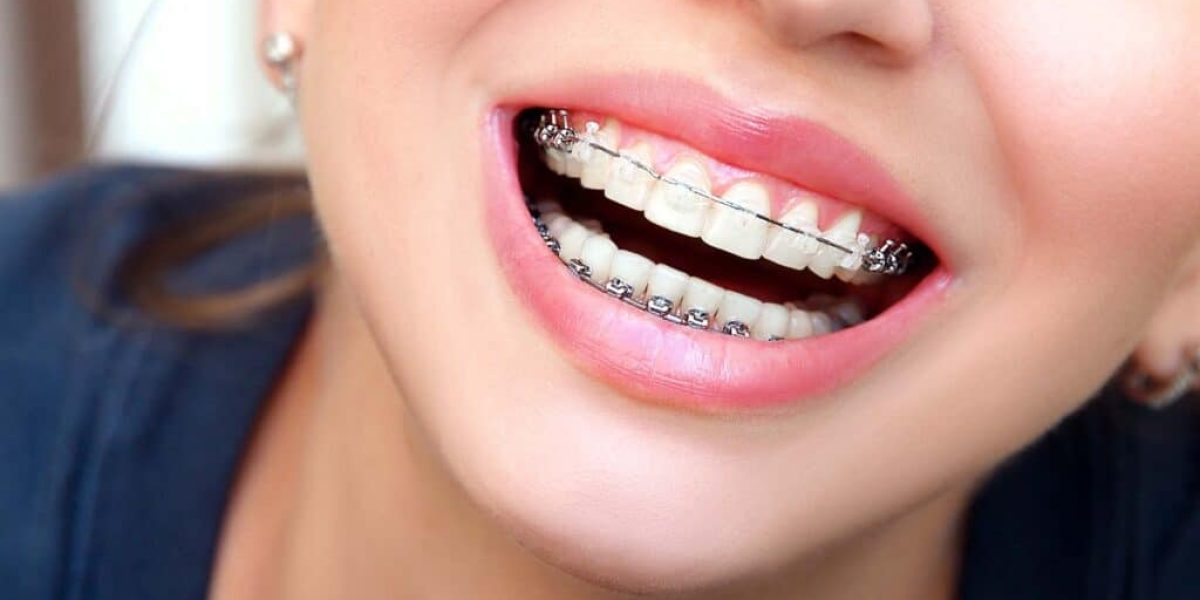How-to-Feel-Confident-While-Wearing-Metal-Braces