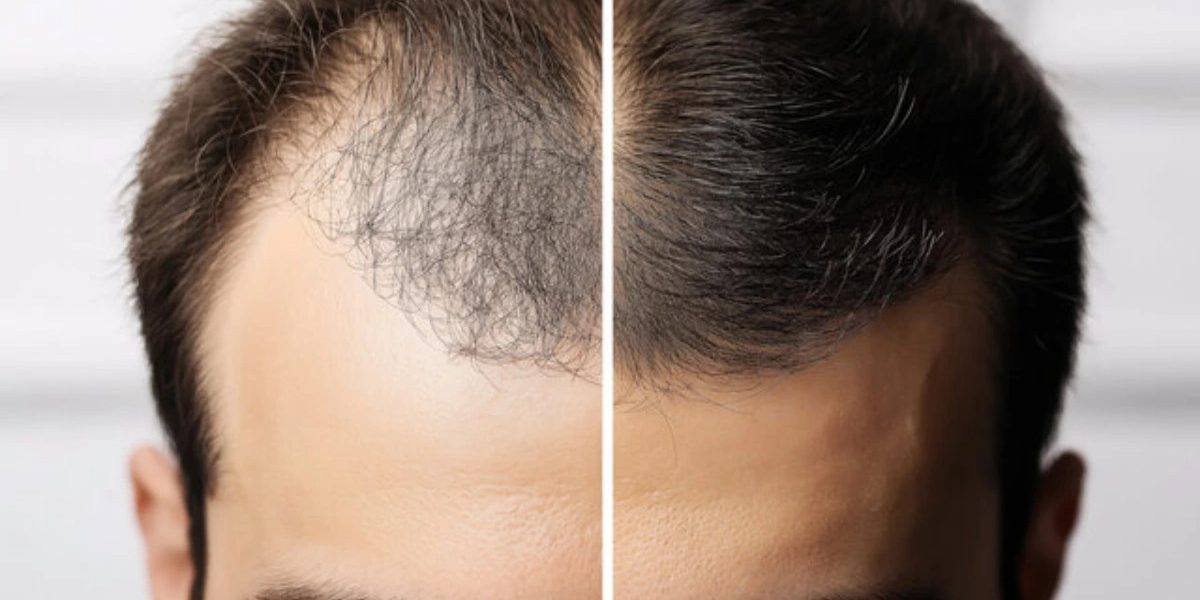 Is-follicular-unit-excision-a-permanent-solution-for-hair-loss