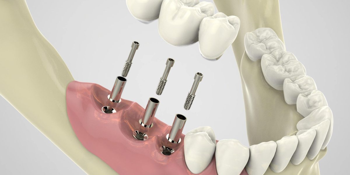 Is-the-Pain-Worth-It-for-Dental-Implants