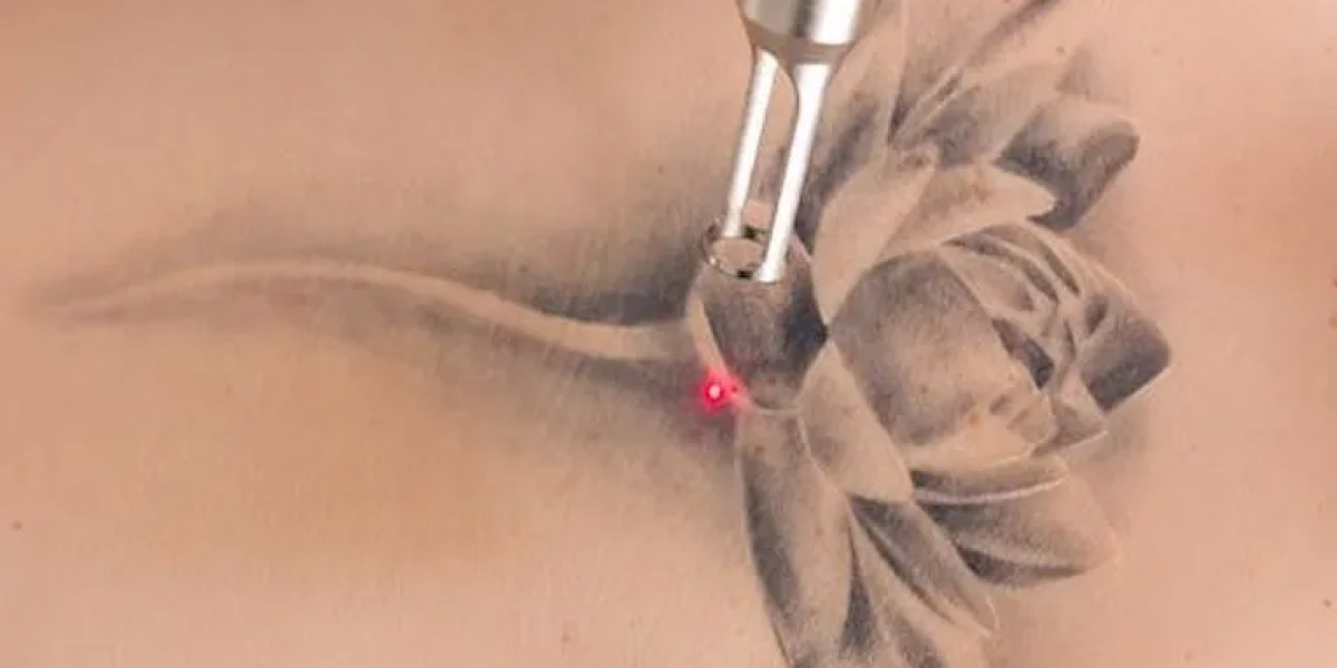 Laser-removal-fades-tattoos-without-invasive-surgery