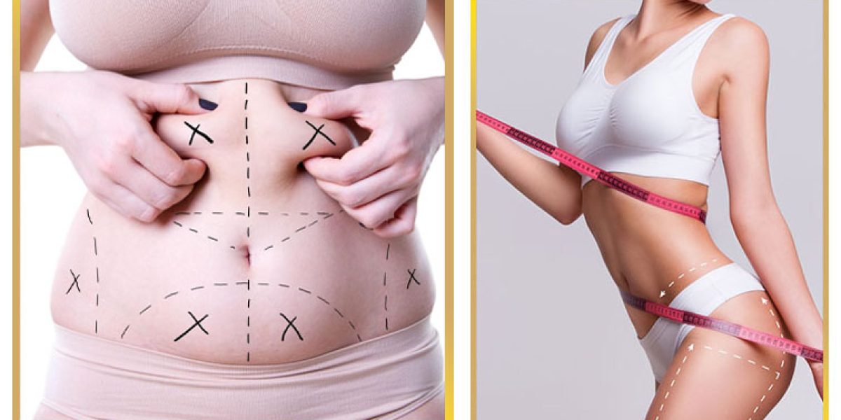 Liposuction-in-Islamabad