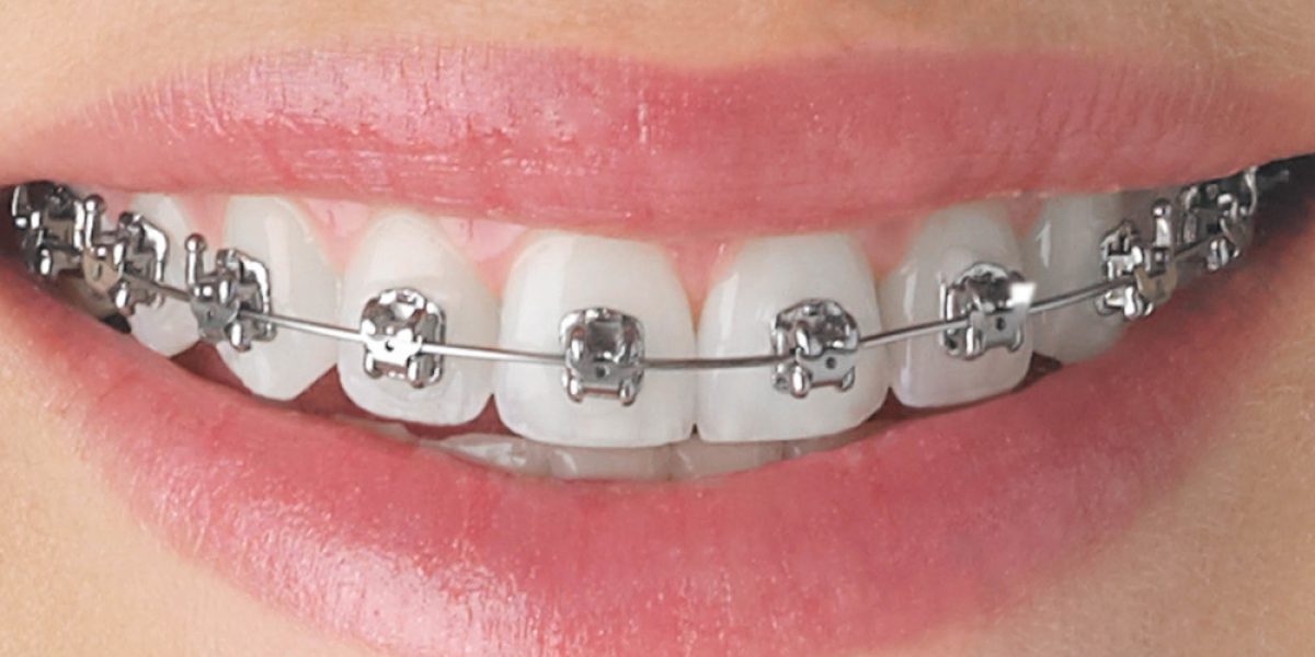 Living-with-Metal-Braces