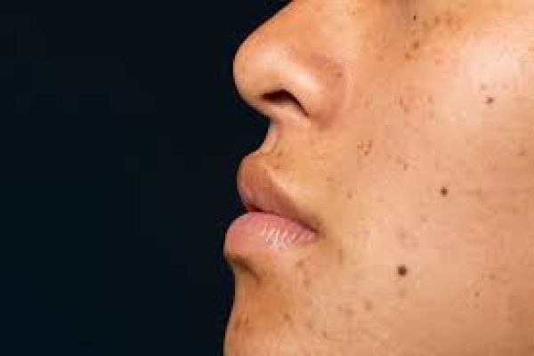 Melasma-improves-with-regular-sunscreen-application