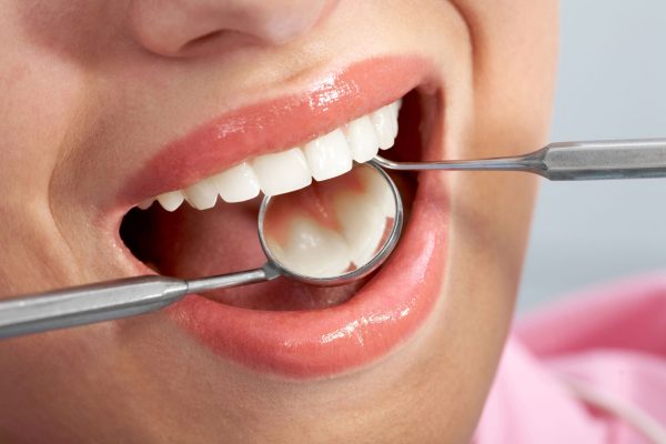 Mercury-in-Fillings-Is-Amalgam-Still-Safe