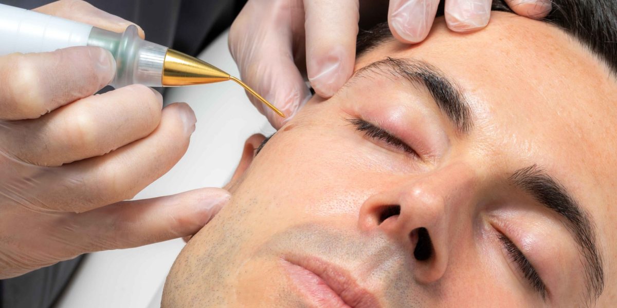Mole-Removal-for-Men-A-Growing-Demand-in-Grooming