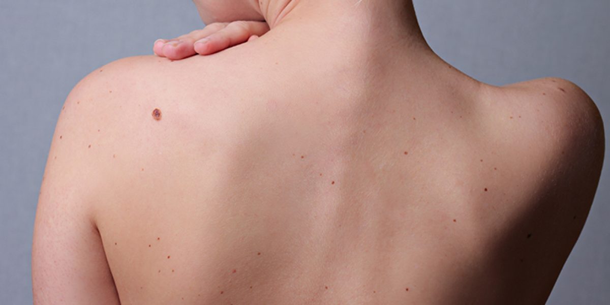 Mole-Removal-in-Dubai-What-You-Should-Know