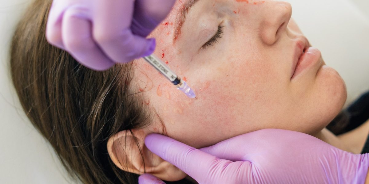 PRP-facial-promotes-smoother-skin-and-fades-acne-scars