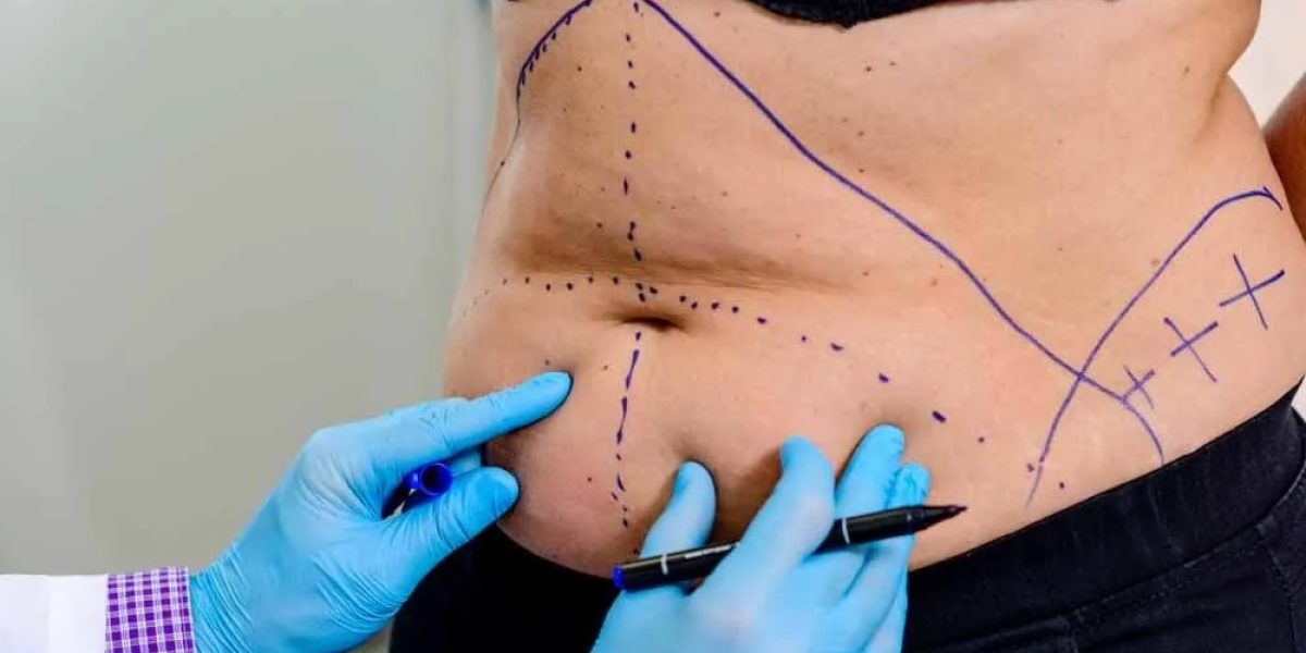 Rejuvenate-your-abdomen-with-a-tummy-tuck-for-lasting-results