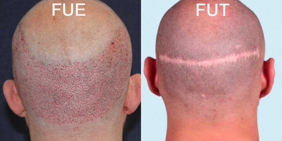Restore-lost-hair-easily