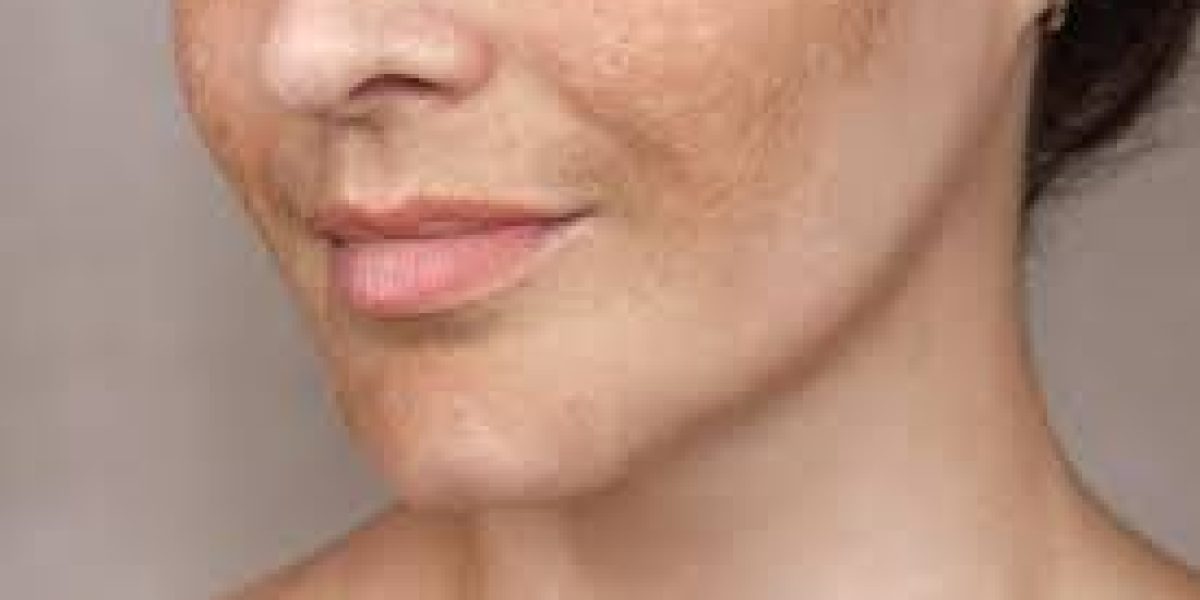 Restore-natural-skin-tone-with-melasma-treatments