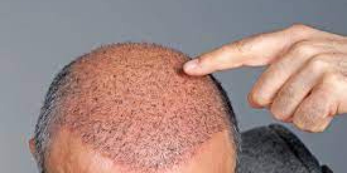 Restore-thinning-hair-with-a-professional-transplant