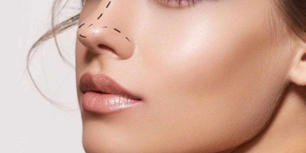 Rhinoplasty-and-Facial-Features-Achieving-a-Balanced-Look