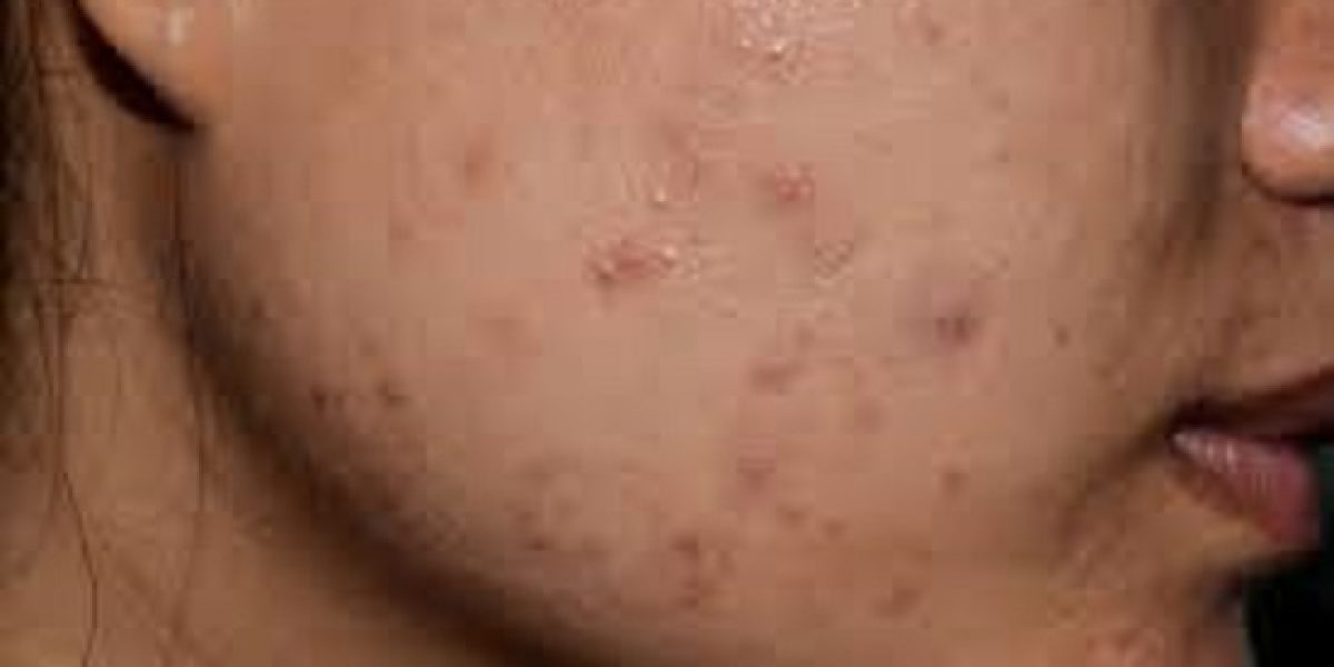 Say-Goodbye-to-Scars-with-the-Right-Scar-Removal