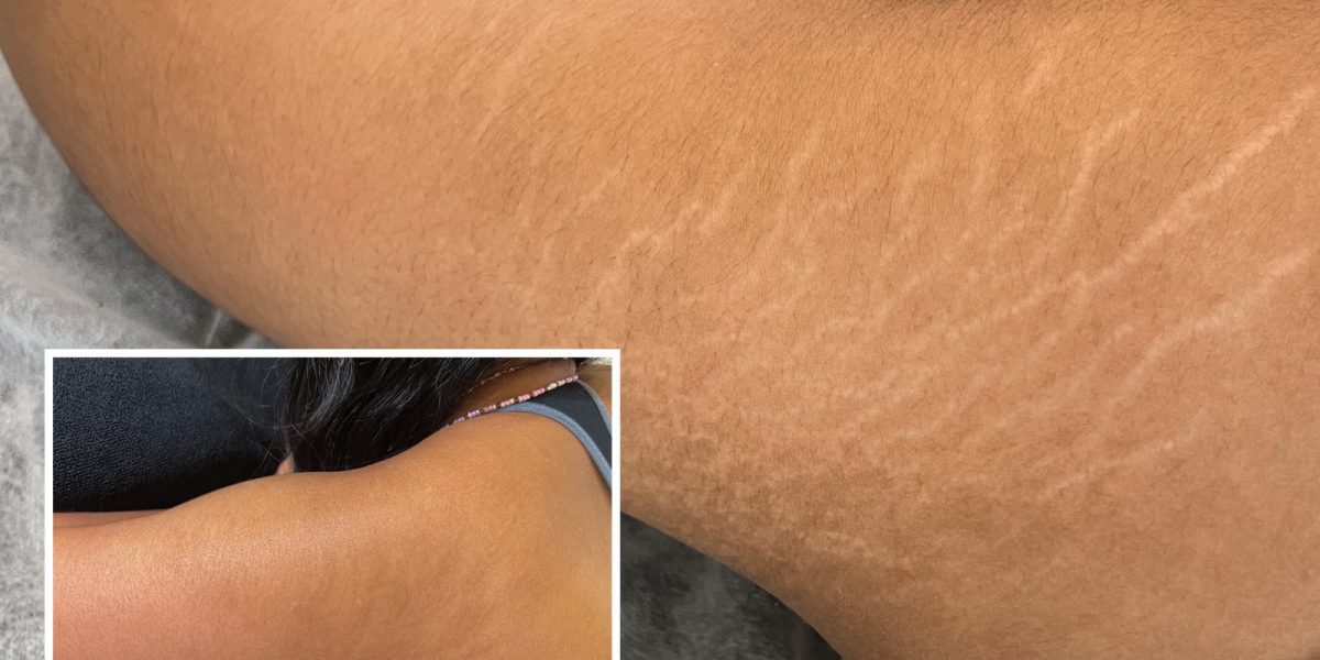 Stretch-mark-removal-treatments