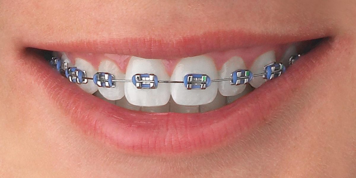 The-Complete-Beginners-Guide-to-Metal-Braces