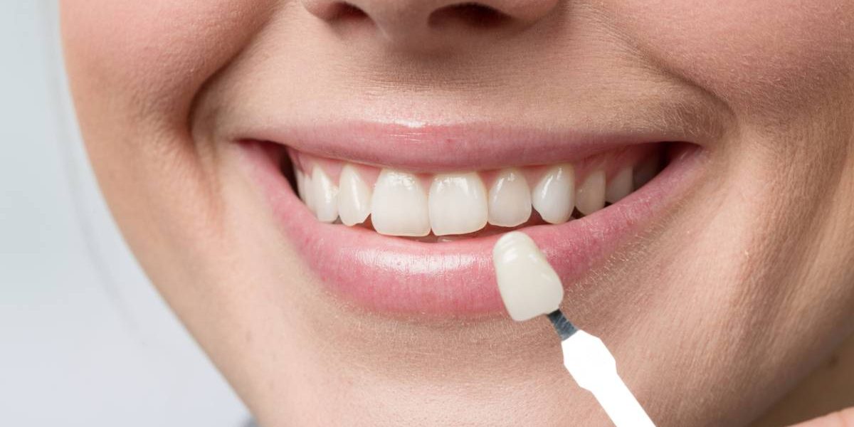The-Difference-Between-E-max-Veneers-and-Crowns-A-Simple-Guide