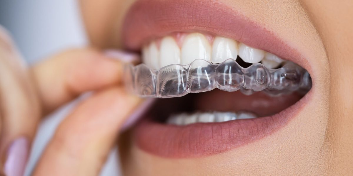 The-Future-of-Smile-Makeovers-Why-Aligners-Are-Taking-Over-Braces