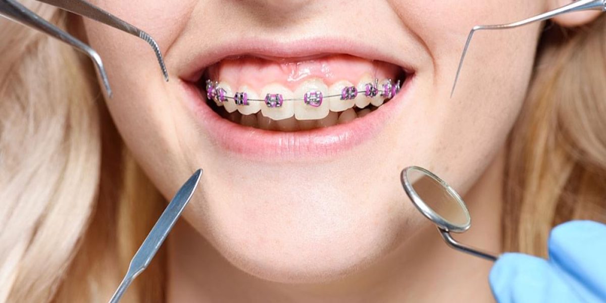 The-Science-Behind-How-Orthodontists-Move-Teeth