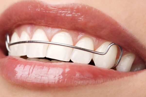 The-Ultimate-Guide-to-Dental-Retainers-What-You-Need-to-Know