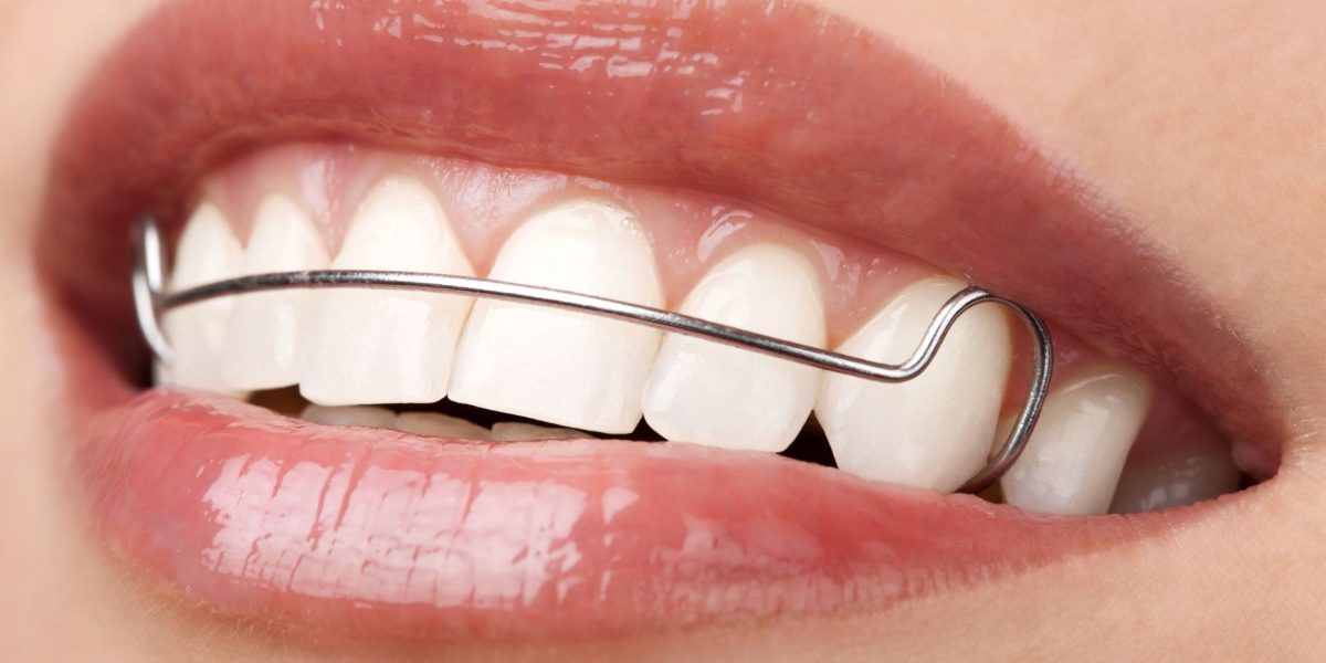 The-Ultimate-Guide-to-Dental-Retainers-What-You-Need-to-Know