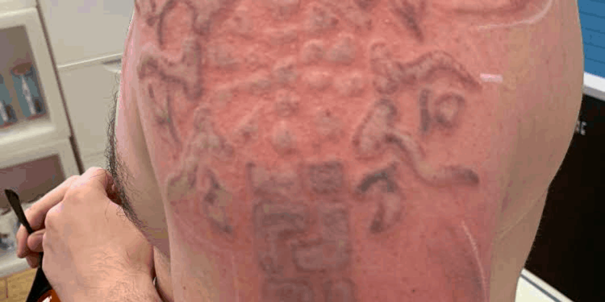 Treat-Signs-of-Injury-After-Laser-Tattoo-Removal