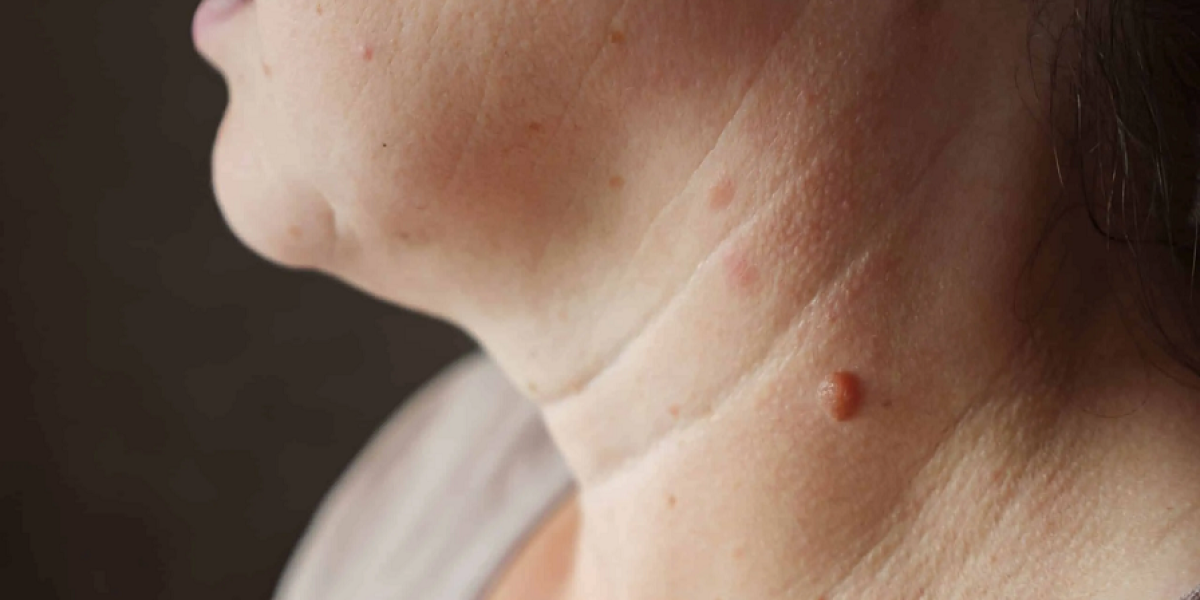 Understanding-Pain-Levels-in-Warts-Removal-Surgery