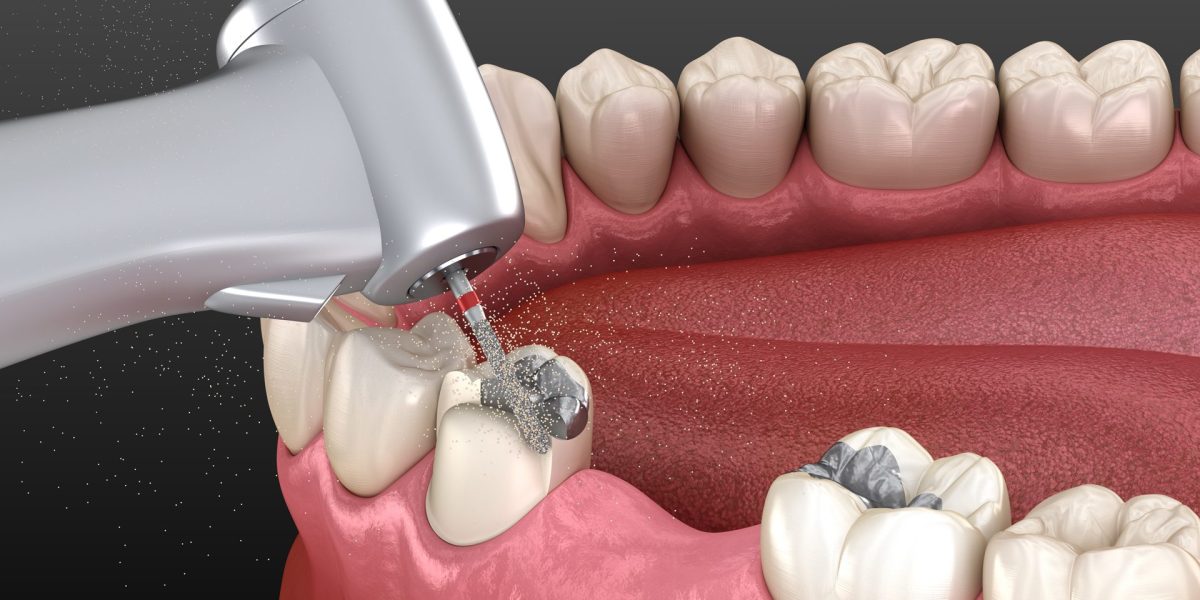 What-Happens-After-Dental-Amalgam-Removal-Healing-and-Care-Tips