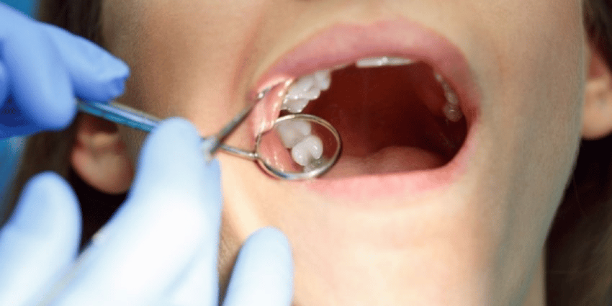 What-to-Expect-Before-During-and-After-Wisdom-Tooth-Extraction