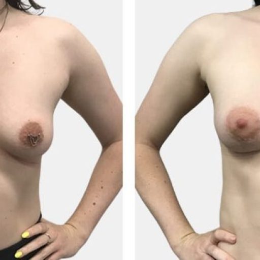 breast-lift-and-augmentation-before-and-after