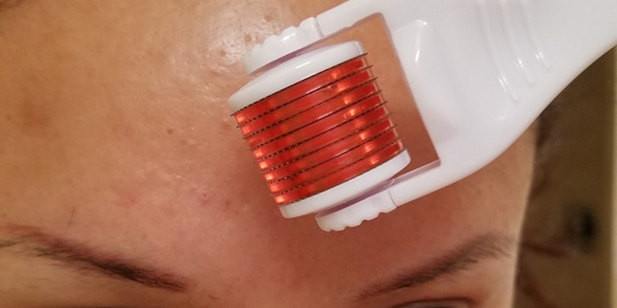 micro-needling-for-acne-scars-hurt-Find-out