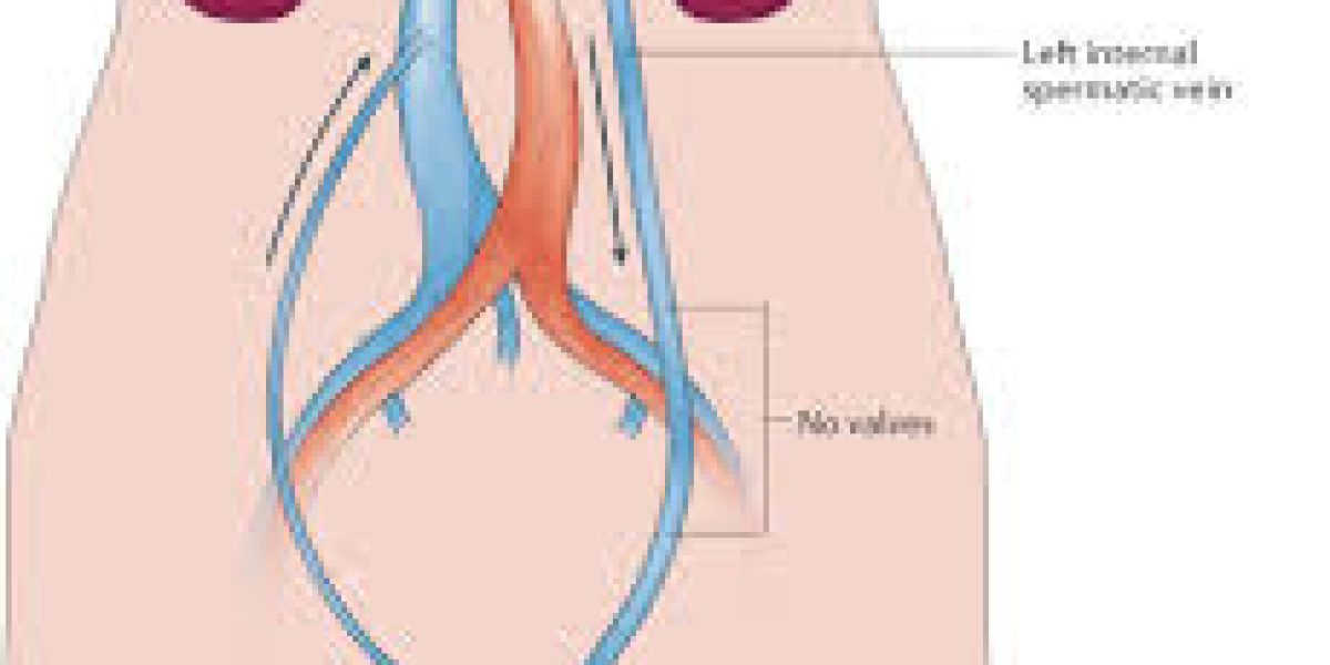 varicocele-embolisation2